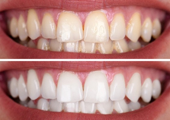 Closeup of patient's teeth before and after teeth whitening treatment