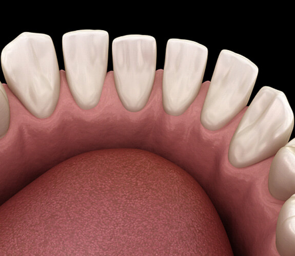 Example of tooth gaps in Marion