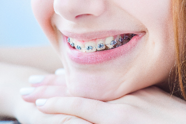 How to use Superfloss with fixed braces. 